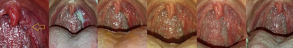 This image shows throat warts (papillomas) before treatment and during the treatment process. Left to right: warts prior to treatment, warts on the day of silver nitrate treatment, warts two days after treatment, warts four days after treatment, warts six days after treatment, and warts remaining nine days after treatment. Wart Treatment Timeline.jpg