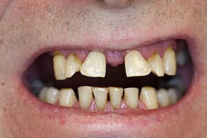 Zahnwanderung wegen Periodontitis OK 02.JPG