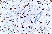 A micrograph showing cells with abnormal p53 expression (brown) in a brain tumor. p53 immunostain. Anaplastic astrocytoma - p53 - very high mag.jpg
