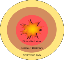 Diagram of a blast injury Anatomy of a Blast.svg