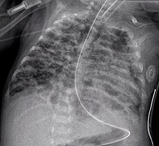 CXR - Bronchopulmonary dysplasia.jpg