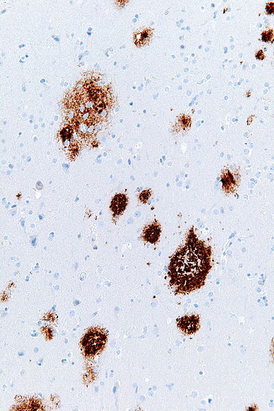 File:Cerebral amyloid angiopathy -2a- amyloid beta - high mag.jpg