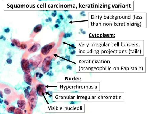 Cytopathology of keratinizing squamous-cell carcinoma.