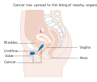 Diagram showing stage 4A cancer of the vulva CRUK 235.svg