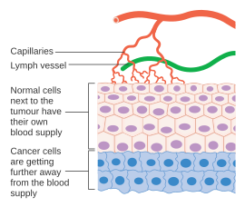 Without angiogenesis a tumor cannot grow beyond a limited size Diagram showing why cancer cells need their own blood supply.svg