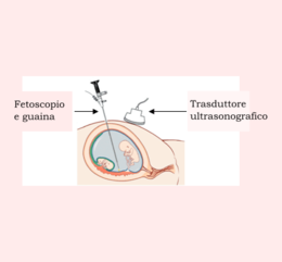 Endoscopie fœtale.png