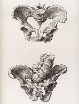 Deforme olmuş kadın pelvis çizimi - açısal distorsiyon Wellcome L0038229.jpg