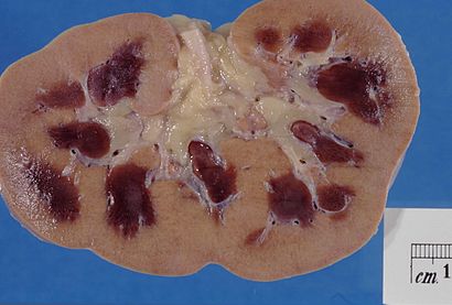 Kidney – acute cortical necrosis.jpg