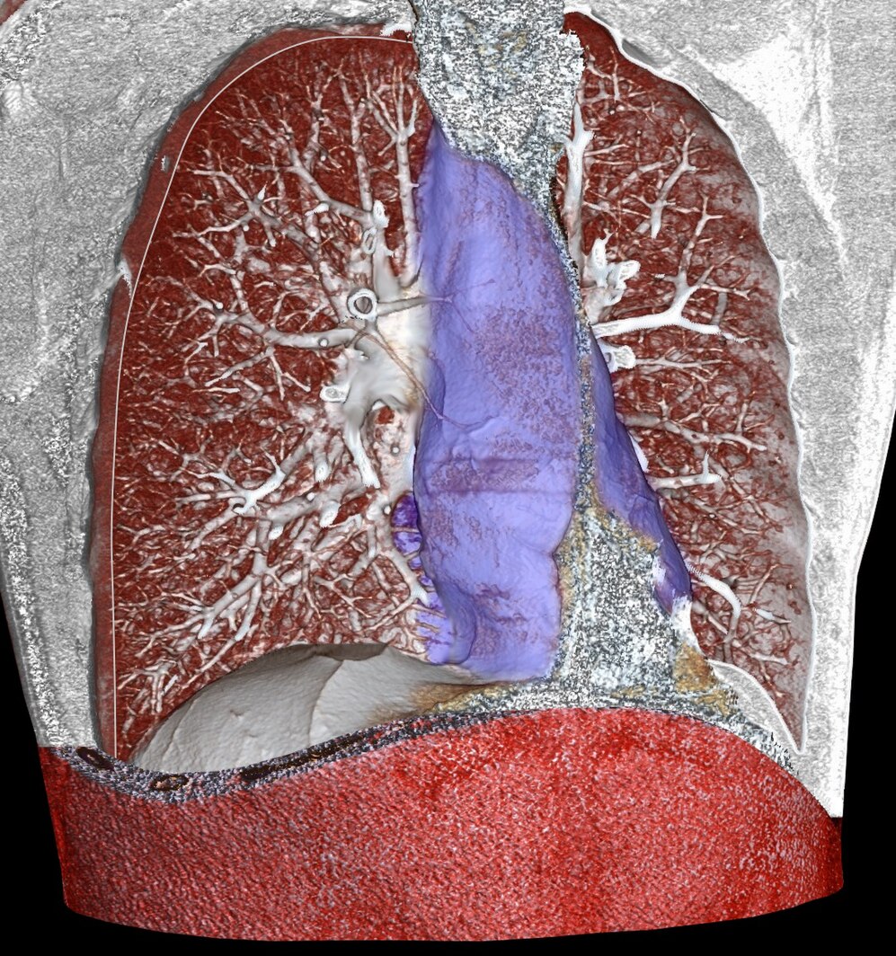 Mediastinum-avatar