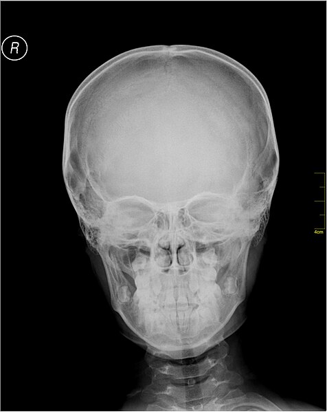 File:Medical X-Ray imaging OTG06 nevit.jpg