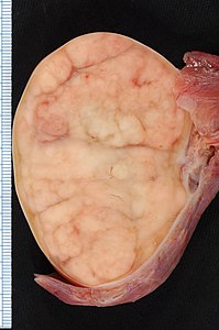 Seminoma of the Testis.jpg