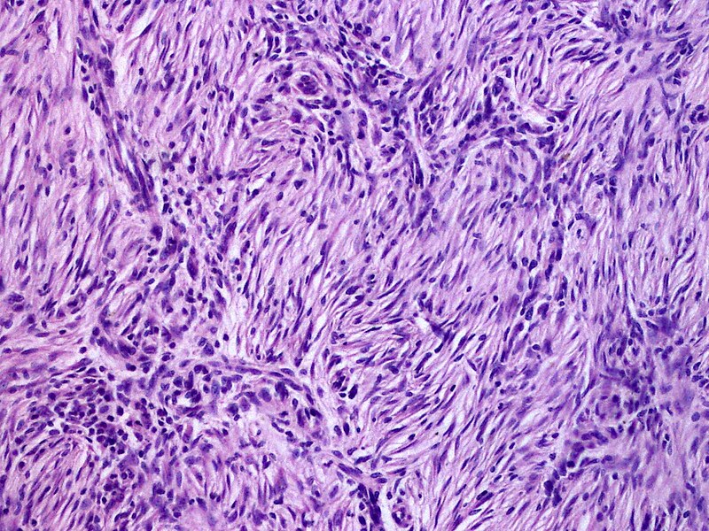 File:SkinTumors-P9270832.JPG