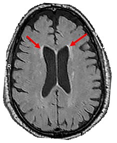 Brain CT of brain showing white matter lesions (indicated by the red arrows) White Matter Lesions (48601156232).jpg