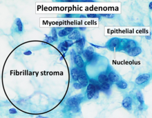 Cytopathology of pleomorphic adenoma.png