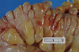 Diverticula, sigmoid colon.jpg