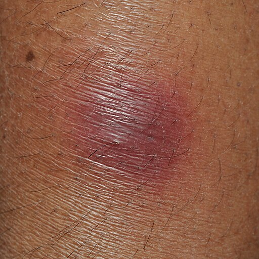 Erythema nodosum - Kolkata 2012-01-03 7753