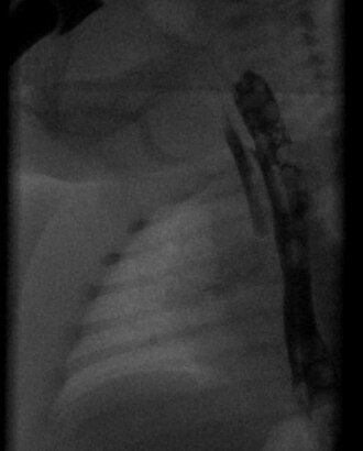 Radiograph with oral contrast showing h-type tracheoesophageal fistula in a newborn H-Fistel neugeb 05032014.jpg