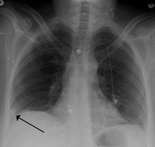 A Hampton hump in a person with a right lower lobe pulmonary embolism Hamptonshump.PNG