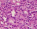 A silent gonadotroph pituitary adenoma which is, in this case, is eosinophilic (contrary to normal, basophilic, gonadotroph cells)