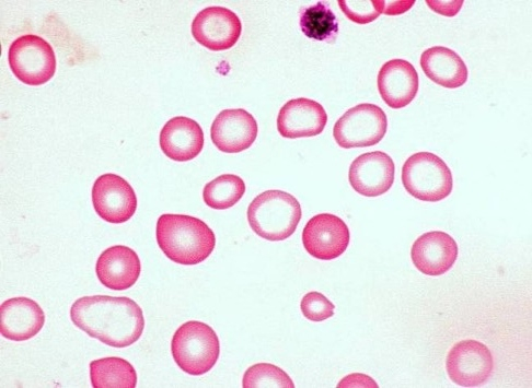 Dosya:Hypochromic microcytic anemia.webp