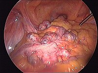 Śródoperacyjny widok uchyłków esicy (operacja laparoskopowa).