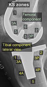 KS (Knee Society) zones, lateral view. Knee prosthesis zones by Knee Society 2015, lateral view.jpg