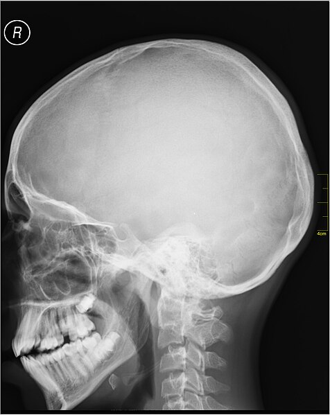 File:Medical X-Ray imaging OFD06 nevit.jpg