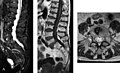 File:Morbus Fabry MRT Osteoporosis 01.jpg