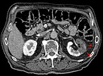 Thumbnail for Renal infarction