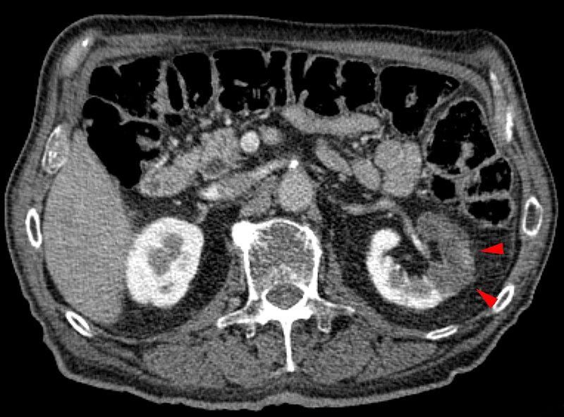 File:Niereninfarkt in der Computertomographie.jpg