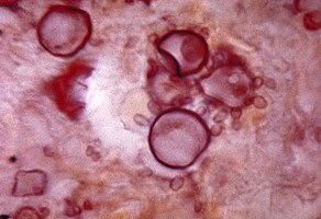 Histopathology of paracoccidiodomycoisis