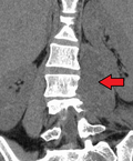 Miniatura para Absceso del psoas