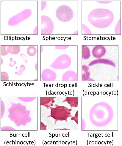 Poikilocytes - Red blood cell types.jpg
