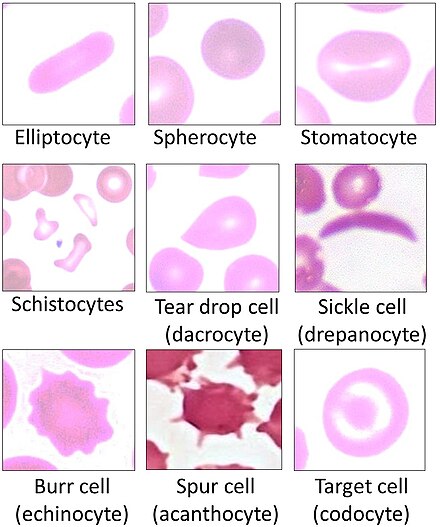 Variations of red blood cell shape, overall termed poikilocytosis.