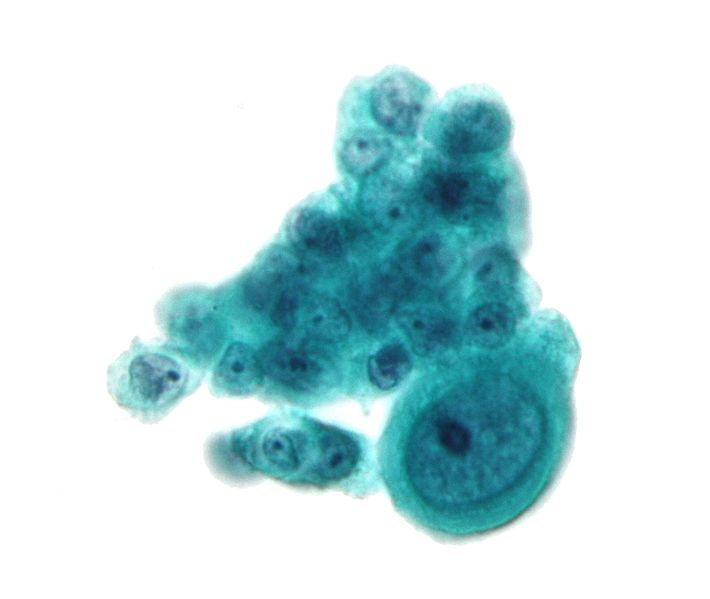 File:Serous carcinoma 2a - cytology.jpg