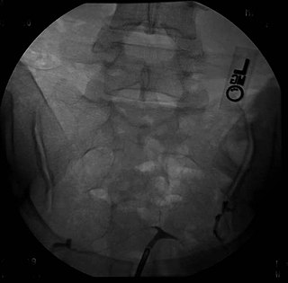 <span class="mw-page-title-main">T-shaped uterus</span> Medical condition