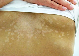 Tinea versicolor condition characterized by a rash on the trunk and proximal extremities