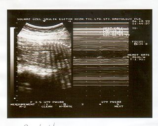 <span class="mw-page-title-main">Biophysical profile</span> Prenatal ultrasound evaluation of fetal well-being