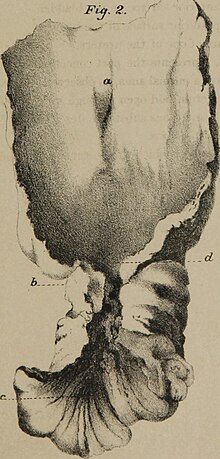 A practical treatise on the aetiology, pathology and treatment of the congenital malformations of the rectum and anus (1860) (14577788859).jpg