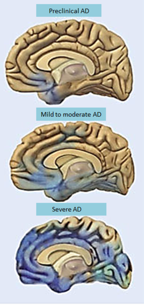 File:Alzheimers disease progression-brain degeneration.PNG