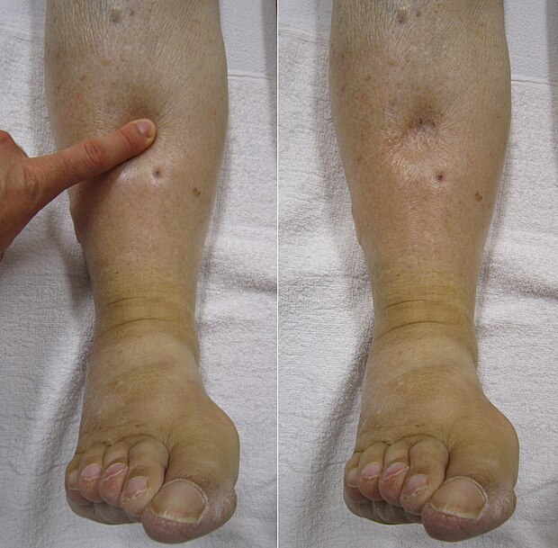 Severe peripheral pitting oedema