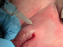 Peniswurzelblock im Rahmen einer Beschneidung