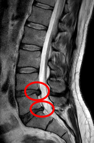 Spinal disc herniation