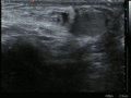 Inguinal hernia ultrasound