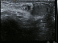 Inguinal hernia ultrasound 0530162900640 8M.gif
