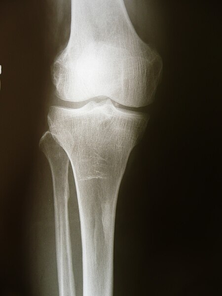 File:Knee 1300271.JPG