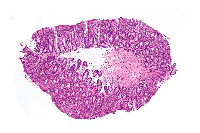 File:Lymphocytic colitis - low mag.jpg