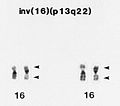 M4EO, pericentric inversion of chromosome 16.jpg
