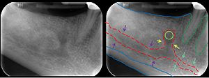 Mandibular Incisive Canal Highlighted.jpg