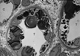 Morbus Fabry kidney biopsy TEM 02.jpg